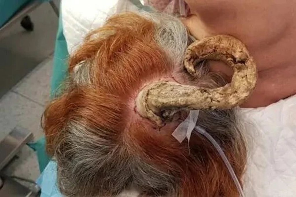 泰國75歲婦人頭上長出26公分的角，就醫後才知道竟是皮膚癌作祟險侵頭骨。（翻攝網路）